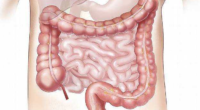 diverticulitis