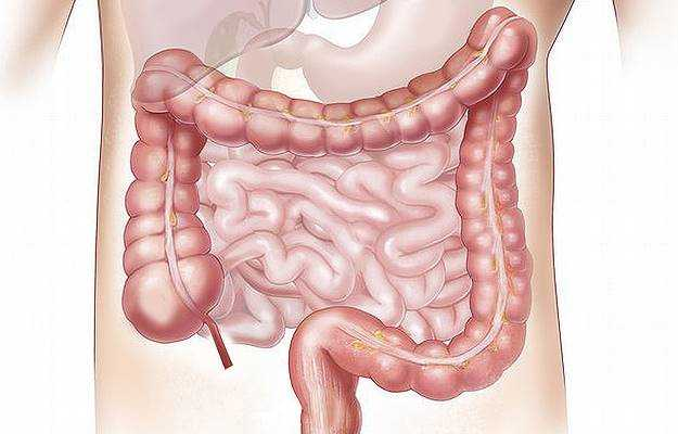 diverticulitis